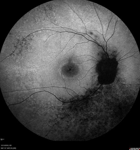 Retinitis Pigmentosa with Cystoid Macular Edema responsive to topical carbonic anhydrase inhibitors
67 year old female  She thought it was time to have her glasses changed.She has no family history of reitnal disease and has never been diagnosed with a problem.   She started having night vision trouble the last year.  Two sisters and a brother with normal vision.  
VA OD: Dcc20/40-2 NccJ3
VA OS: Dcc20/20 NccJ1
IOP: TP: OD:9
