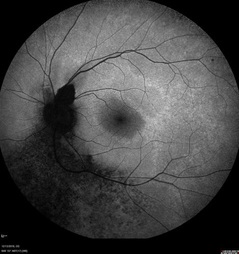 Retinitis Pigmentosa with Cystoid Macular Edema responsive to topical carbonic anhydrase inhibitors
67 year old female  She thought it was time to have her glasses changed.She has no family history of reitnal disease and has never been diagnosed with a problem.   She started having night vision trouble the last year.  Two sisters and a brother with normal vision.  
VA OD: Dcc20/40-2 NccJ3
VA OS: Dcc20/20 NccJ1
IOP: TP: OD:9
