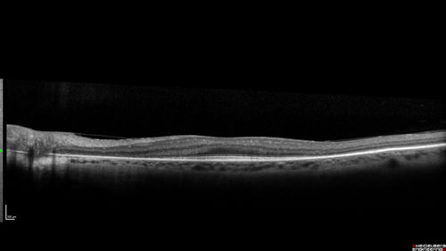 Retinitis Pigmentosa with Cystoid Macular Edema responsive to topical carbonic anhydrase inhibitors
67 year old female  She thought it was time to have her glasses changed.She has no family history of reitnal disease and has never been diagnosed with a problem.   She started having night vision trouble the last year.  Two sisters and a brother with normal vision.  
VA OD: Dcc20/40-2 NccJ3
VA OS: Dcc20/20 NccJ1
IOP: TP: OD:9

