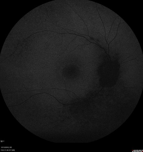 Retinitis Pigmentosa with Cystoid Macular Edema responsive to topical carbonic anhydrase inhibitors
67 year old female  She thought it was time to have her glasses changed.She has no family history of reitnal disease and has never been diagnosed with a problem.   She started having night vision trouble the last year.  Two sisters and a brother with normal vision.  
VA OD: Dcc20/40-2 NccJ3
VA OS: Dcc20/20 NccJ1
IOP: TP: OD:9
