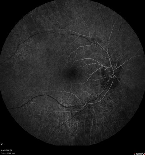 Retinitis Pigmentosa with Cystoid Macular Edema responsive to topical carbonic anhydrase inhibitors
67 year old female  She thought it was time to have her glasses changed.She has no family history of reitnal disease and has never been diagnosed with a problem.   She started having night vision trouble the last year.  Two sisters and a brother with normal vision.  
VA OD: Dcc20/40-2 NccJ3
VA OS: Dcc20/20 NccJ1
IOP: TP: OD:9
