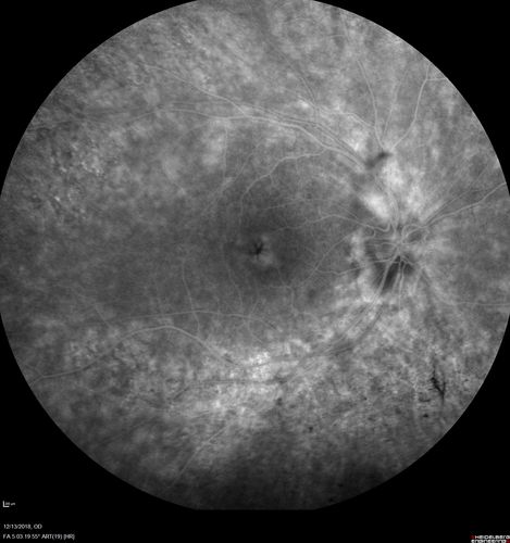 Retinitis Pigmentosa with Cystoid Macular Edema responsive to topical carbonic anhydrase inhibitors
67 year old female  She thought it was time to have her glasses changed.She has no family history of reitnal disease and has never been diagnosed with a problem.   She started having night vision trouble the last year.  Two sisters and a brother with normal vision.  
VA OD: Dcc20/40-2 NccJ3
VA OS: Dcc20/20 NccJ1
IOP: TP: OD:9
