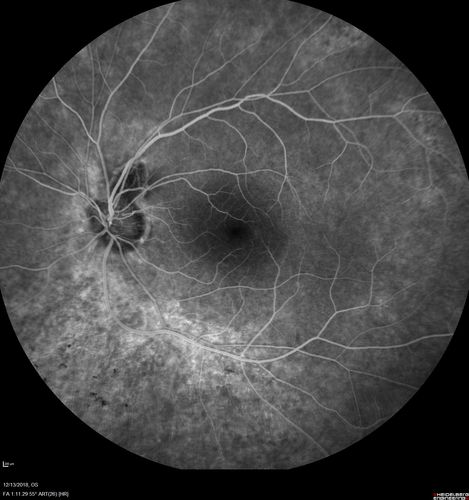 Retinitis Pigmentosa with Cystoid Macular Edema responsive to topical carbonic anhydrase inhibitors
67 year old female  She thought it was time to have her glasses changed.She has no family history of reitnal disease and has never been diagnosed with a problem.   She started having night vision trouble the last year.  Two sisters and a brother with normal vision.  
VA OD: Dcc20/40-2 NccJ3
VA OS: Dcc20/20 NccJ1
IOP: TP: OD:9
