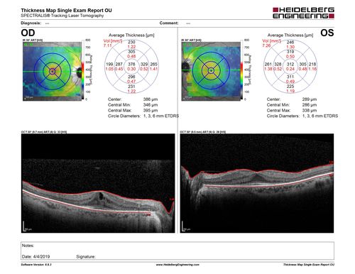 Retinitis Pigmentosa with Cystoid Macular Edema responsive to topical carbonic anhydrase inhibitors
67 year old female  She thought it was time to have her glasses changed.She has no family history of reitnal disease and has never been diagnosed with a problem.   She started having night vision trouble the last year.  Two sisters and a brother with normal vision.  
VA OD: Dcc20/40-2 NccJ3
VA OS: Dcc20/20 NccJ1
IOP: TP: OD:9
