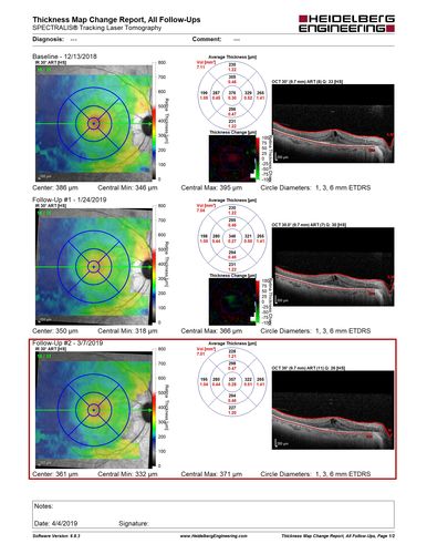 Retinitis Pigmentosa with Cystoid Macular Edema responsive to topical carbonic anhydrase inhibitors
67 year old female  She thought it was time to have her glasses changed.She has no family history of reitnal disease and has never been diagnosed with a problem.   She started having night vision trouble the last year.  Two sisters and a brother with normal vision.  
VA OD: Dcc20/40-2 NccJ3
VA OS: Dcc20/20 NccJ1
IOP: TP: OD:9
