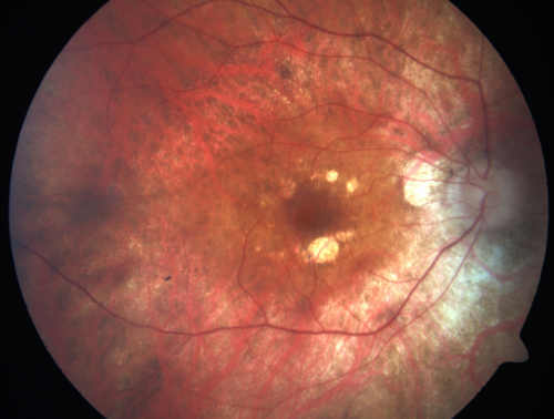 Retinitis Pigmentosa - RP1 Mutation
78 year old man: 20/32 OD and 20/50 OS -  RP1 Gene is Bad -- > RP with Novel Amino Acid Change in GLY723Stop sequence of the RP1 gene - consistent with AD RP
