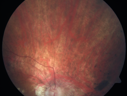 Retinitis Pigmentosa - RP1 Mutation
78 year old man: 20/32 OD and 20/50 OS -  RP1 Gene is Bad -- > RP with Novel Amino Acid Change in GLY723Stop sequence of the RP1 gene - consistent with AD RP

