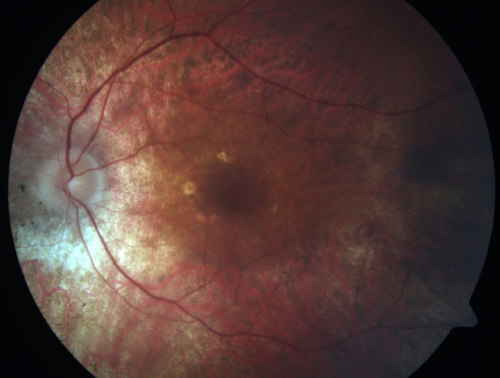 Retinitis Pigmentosa - RP1 Mutation
78 year old man: 20/32 OD and 20/50 OS -  RP1 Gene is Bad -- > RP with Novel Amino Acid Change in GLY723Stop sequence of the RP1 gene - consistent with AD RP
