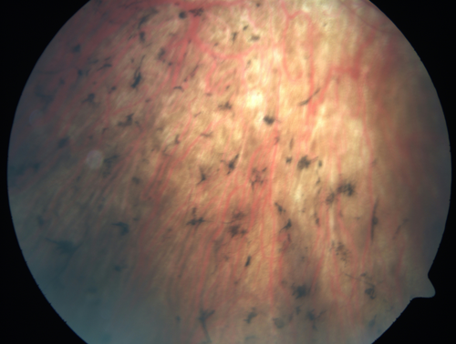 Retinitis Pigmentosa - RP1 Mutation
78 year old man: 20/32 OD and 20/50 OS -  RP1 Gene is Bad -- > RP with Novel Amino Acid Change in GLY723Stop sequence of the RP1 gene - consistent with AD RP
