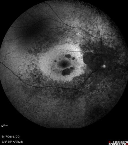 Retinitis Pigmentosa - RP1 Mutation
78 year old man: 20/32 OD and 20/50 OS -  RP1 Gene is Bad -- > RP with Novel Amino Acid Change in GLY723Stop sequence of the RP1 gene - consistent with AD RP
