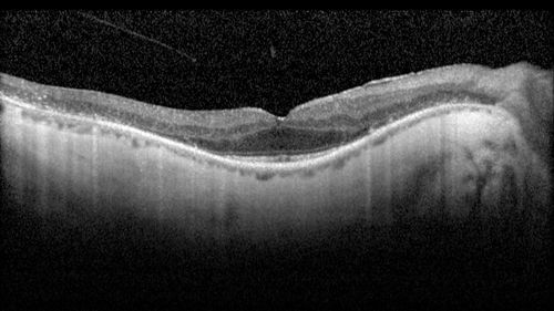 Retinitis Pigmentosa - RP1 Mutation
78 year old man: 20/32 OD and 20/50 OS -  RP1 Gene is Bad -- > RP with Novel Amino Acid Change in GLY723Stop sequence of the RP1 gene - consistent with AD RP
