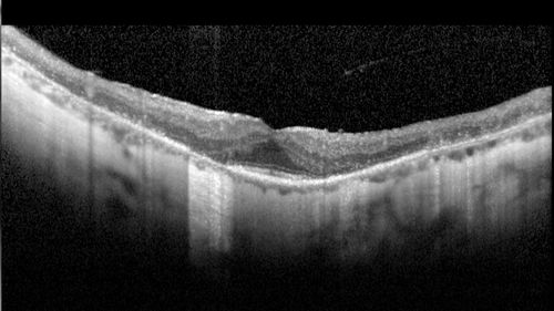 Retinitis Pigmentosa - RP1 Mutation
78 year old man: 20/32 OD and 20/50 OS -  RP1 Gene is Bad -- > RP with Novel Amino Acid Change in GLY723Stop sequence of the RP1 gene - consistent with AD RP
