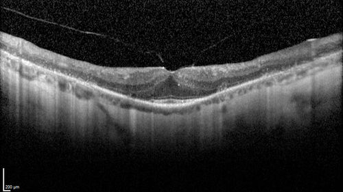 Retinitis Pigmentosa - RP1 Mutation
78 year old man: 20/32 OD and 20/50 OS -  RP1 Gene is Bad -- > RP with Novel Amino Acid Change in GLY723Stop sequence of the RP1 gene - consistent with AD RP
