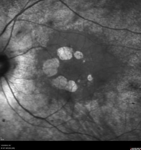 Retinitis Pigmentosa - RP1 Mutation
78 year old man: 20/32 OD and 20/50 OS -  RP1 Gene is Bad -- > RP with Novel Amino Acid Change in GLY723Stop sequence of the RP1 gene - consistent with AD RP

