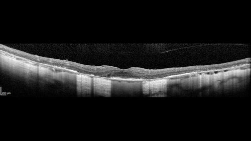 Retinitis Pigmentosa - RP1 Mutation
78 year old man: 20/32 OD and 20/50 OS -  RP1 Gene is Bad -- > RP with Novel Amino Acid Change in GLY723Stop sequence of the RP1 gene - consistent with AD RP
