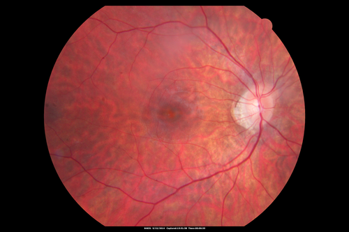 Retinitis Pigmentosa Sine Pigmento 
