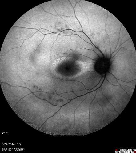 Retinitis Pigmentosa Sine Pigmento 
