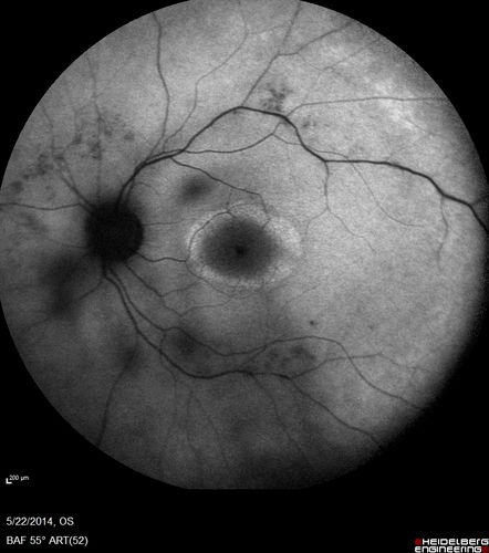 Retinitis Pigmentosa Sine Pigmento 
