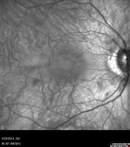 Retinitis Pigmentosa Sine Pigmento 
