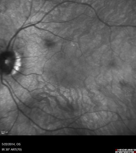 Retinitis Pigmentosa Sine Pigmento 
