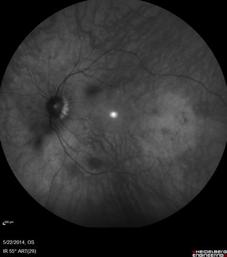 Retinitis Pigmentosa Sine Pigmento 
