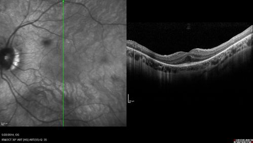 Retinitis Pigmentosa Sine Pigmento 
