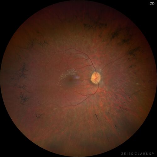 Usher Syndrome - USH2A
23 year old female Extended HPI: Vision trouble for about five years. She has some trouble with night vision and was told that her retina looked abnormal.  There are no family members that are known to have an inherited retinal disease. 
Medical Hx: Sensorial Neural Hearing Loss. Chorionic migranes. 
Systemic Meds: None.
VA 20/32 OD, 20/25 OS
Color vision normal

Heterozygous for USH2A pathological mutation and for an USH2A VUS
