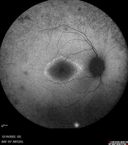 Usher Syndrome - USH2A
23 year old female Extended HPI: Vision trouble for about five years. She has some trouble with night vision and was told that her retina looked abnormal.  There are no family members that are known to have an inherited retinal disease. 
Medical Hx: Sensorial Neural Hearing Loss. Chorionic migranes. 
Systemic Meds: None.
VA 20/32 OD, 20/25 OS
Color vision normal

Heterozygous for USH2A pathological mutation and for an USH2A VUS
