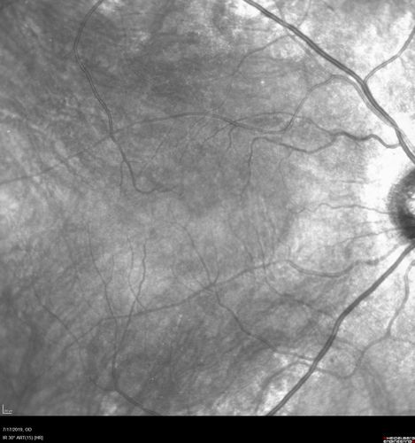 Retinitis Pigmentosa - Autosomal Recessive - 20/25 Vision
49 year old man 15 years ago he noticed decreased night vision.  
VA OD: sc20/25 NscJ2
VA OS: sc20/25-2 NscJ2-1
IOP: TP: OD:17 OS:19 

Genetic testing showed heterozygous for RPE65 - Probably not clinically important
