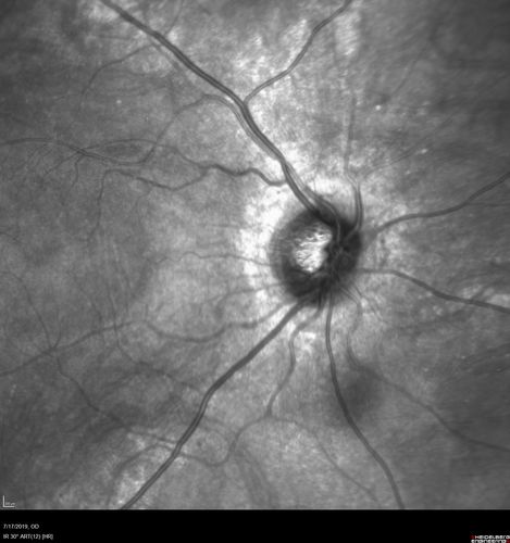 Retinitis Pigmentosa - Autosomal Recessive - 20/25 Vision
49 year old man 15 years ago he noticed decreased night vision.  
VA OD: sc20/25 NscJ2
VA OS: sc20/25-2 NscJ2-1
IOP: TP: OD:17 OS:19 

Genetic testing showed heterozygous for RPE65 - Probably not clinically important
