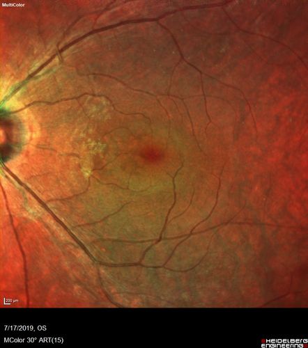 Retinitis Pigmentosa - Autosomal Recessive - 20/25 Vision
49 year old man 15 years ago he noticed decreased night vision.  
VA OD: sc20/25 NscJ2
VA OS: sc20/25-2 NscJ2-1
IOP: TP: OD:17 OS:19 

Genetic testing showed heterozygous for RPE65 - Probably not clinically important
