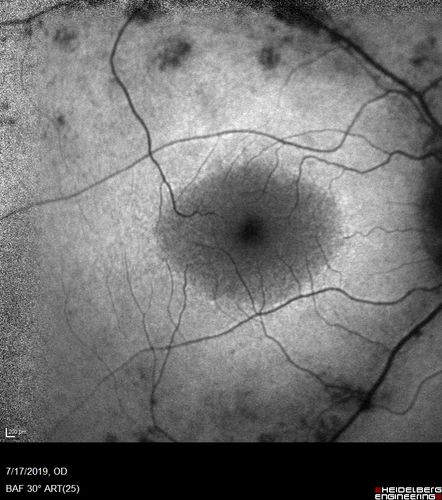 Retinitis Pigmentosa - Autosomal Recessive - 20/25 Vision
49 year old man 15 years ago he noticed decreased night vision.  
VA OD: sc20/25 NscJ2
VA OS: sc20/25-2 NscJ2-1
IOP: TP: OD:17 OS:19 

Genetic testing showed heterozygous for RPE65 - Probably not clinically important
