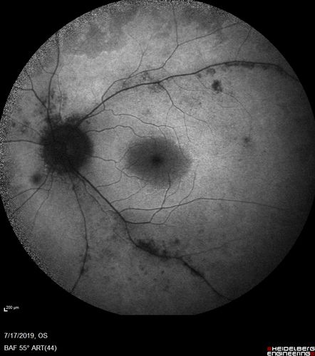 Retinitis Pigmentosa - Autosomal Recessive - 20/25 Vision
49 year old man 15 years ago he noticed decreased night vision.  
VA OD: sc20/25 NscJ2
VA OS: sc20/25-2 NscJ2-1
IOP: TP: OD:17 OS:19 

Genetic testing showed heterozygous for RPE65 - Probably not clinically important
