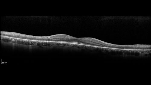 Retinitis Pigmentosa - Autosomal Recessive - 20/25 Vision
49 year old man 15 years ago he noticed decreased night vision.  
VA OD: sc20/25 NscJ2
VA OS: sc20/25-2 NscJ2-1
IOP: TP: OD:17 OS:19 

Genetic testing showed heterozygous for RPE65 - Probably not clinically important
