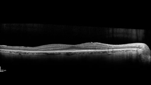Retinitis Pigmentosa - Autosomal Recessive - 20/25 Vision
49 year old man 15 years ago he noticed decreased night vision.  
VA OD: sc20/25 NscJ2
VA OS: sc20/25-2 NscJ2-1
IOP: TP: OD:17 OS:19 

Genetic testing showed heterozygous for RPE65 - Probably not clinically important
