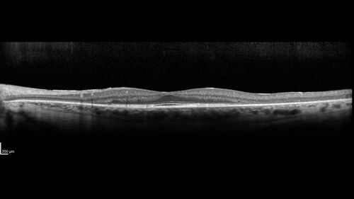 Retinitis Pigmentosa - Autosomal Recessive - 20/25 Vision
49 year old man 15 years ago he noticed decreased night vision.  
VA OD: sc20/25 NscJ2
VA OS: sc20/25-2 NscJ2-1
IOP: TP: OD:17 OS:19 

Genetic testing showed heterozygous for RPE65 - Probably not clinically important
