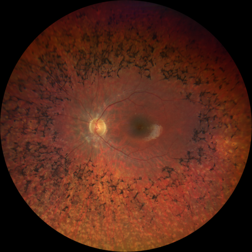 Retinitis Pigmentosa - Simplex - 16 year old female good vision
Difficulty with night vision
No family history
VA 20/25 OD, 20/16 OS
Negative for RPE65
