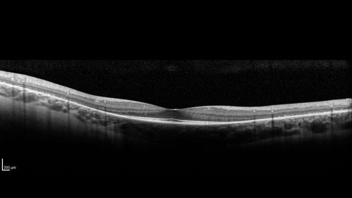 Retinitis Pigmentosa - Simplex - 16 year old female good vision
Difficulty with night vision
No family history
VA 20/25 OD, 20/16 OS
Negative for RPE65
