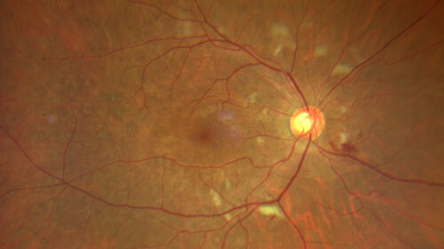 Radiation Retinopathy Both Eyes - 2023 - Two years after radiation for ocular lymphoma 
