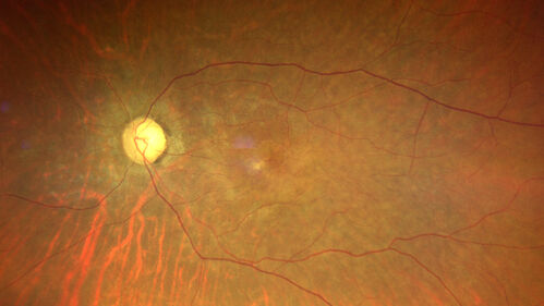 Radiation Retinopathy Both Eyes - 2023 - Two years after radiation for ocular lymphoma  (1)

