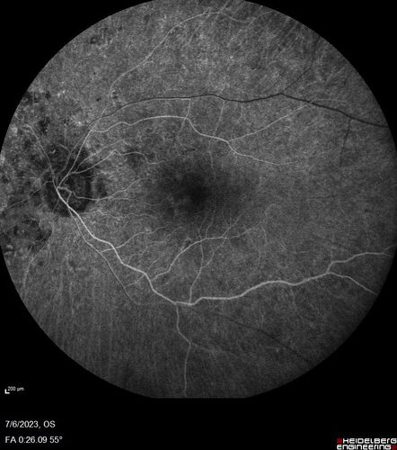 Radiation Retinopathy Both Eyes - 2023 - Two years after radiation for ocular lymphoma  (14)
