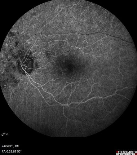 Radiation Retinopathy Both Eyes - 2023 - Two years after radiation for ocular lymphoma  (15)
