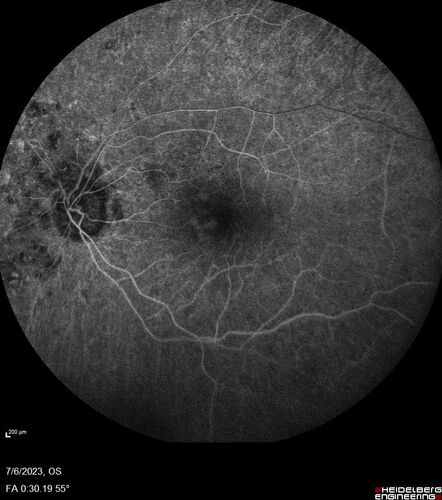 Radiation Retinopathy Both Eyes - 2023 - Two years after radiation for ocular lymphoma  (16)
