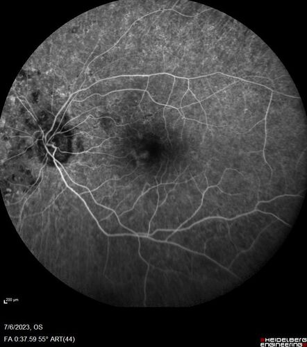 Radiation Retinopathy Both Eyes - 2023 - Two years after radiation for ocular lymphoma  (17)
