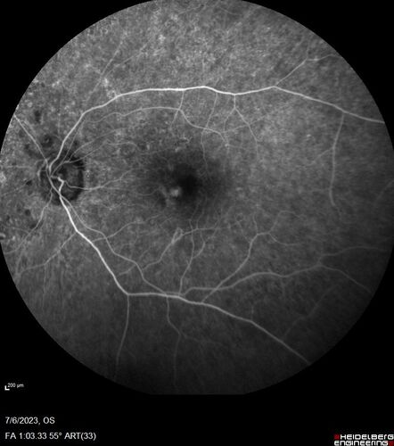 Radiation Retinopathy Both Eyes - 2023 - Two years after radiation for ocular lymphoma  (18)
