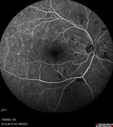 Radiation Retinopathy Both Eyes - 2023 - Two years after radiation for ocular lymphoma  (22)
