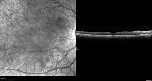 Radiation Retinopathy Both Eyes - 2023 - Two years after radiation for ocular lymphoma  (5)
