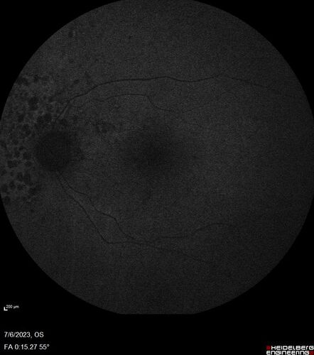 Radiation Retinopathy Both Eyes - 2023 - Two years after radiation for ocular lymphoma  (7)
