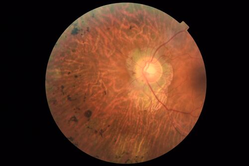 Retinitis Pigmentosa - X-linked Recessive
60 year old man The vision in the right eye is blurry recently.  He has trouble with night vision for about 3 years.  His brother has eye disease in Michigan.  
VA OD: Dcc20/32-1 PHNI NccJ1-1
VA OS: Dcc20/20 NccJ1+-1
IOP: TP: OD:36 OS:18 
He has pseudoexfoliative glaucoma in the right eye.

