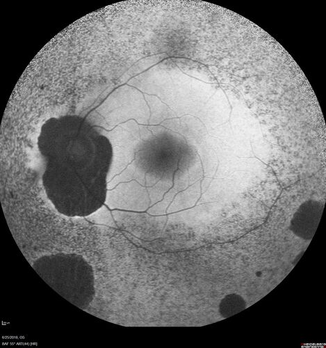 Retinitis Pigmentosa - X-linked Recessive
60 year old man The vision in the right eye is blurry recently.  He has trouble with night vision for about 3 years.  His brother has eye disease in Michigan.  
VA OD: Dcc20/32-1 PHNI NccJ1-1
VA OS: Dcc20/20 NccJ1+-1
IOP: TP: OD:36 OS:18 
He has pseudoexfoliative glaucoma in the right eye.
